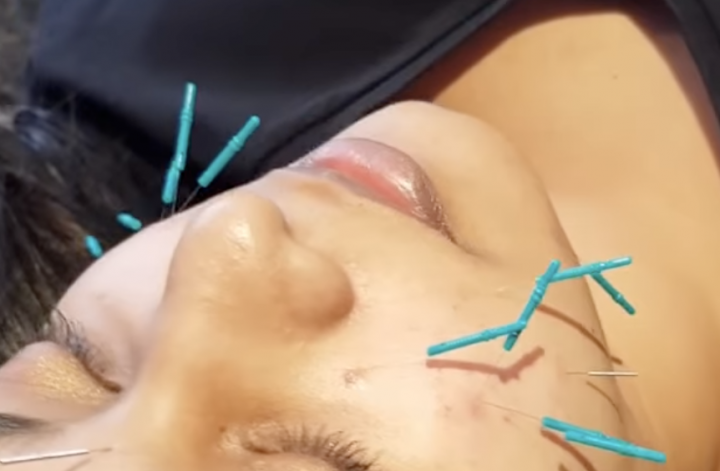 facial acupuncture